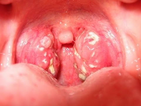 Hình ảnh bệnh lậu ở nữ giới