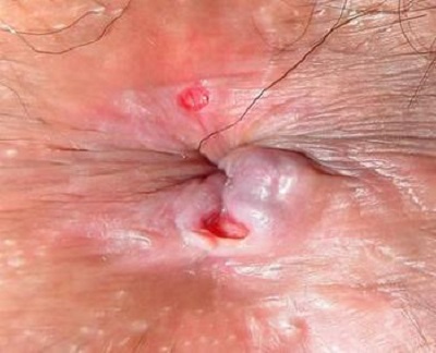 Hình ảnh sùi mào gà ở hậu môn