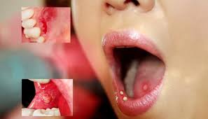 Hình ảnh sùi mào gà ở miệng