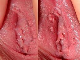 Hình ảnh sùi mào gà ở bộ phân sinh dục nữ