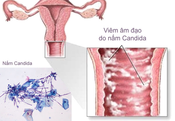thuoc-dat-am-dao-tri-nam-candida-hieu-qua